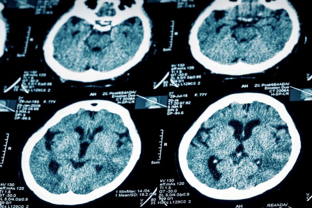 Howie Sacks and Henry / Expertise / Brain Injuries