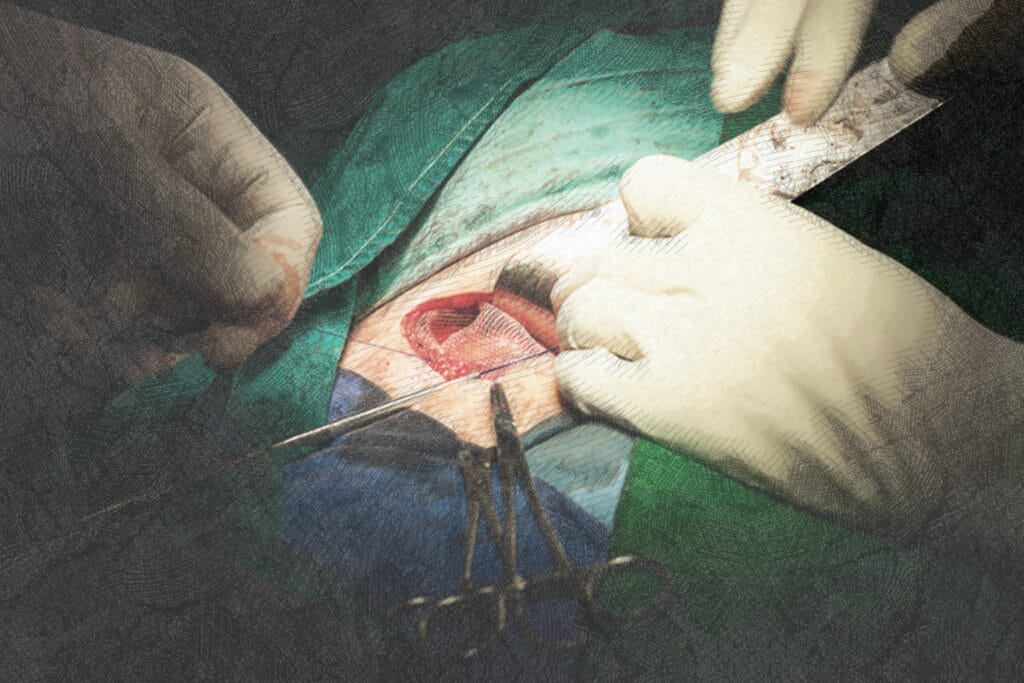 Inguinal Hernia Surgery