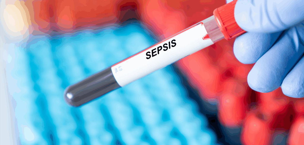 Sepsis disease blood test in doctor hand