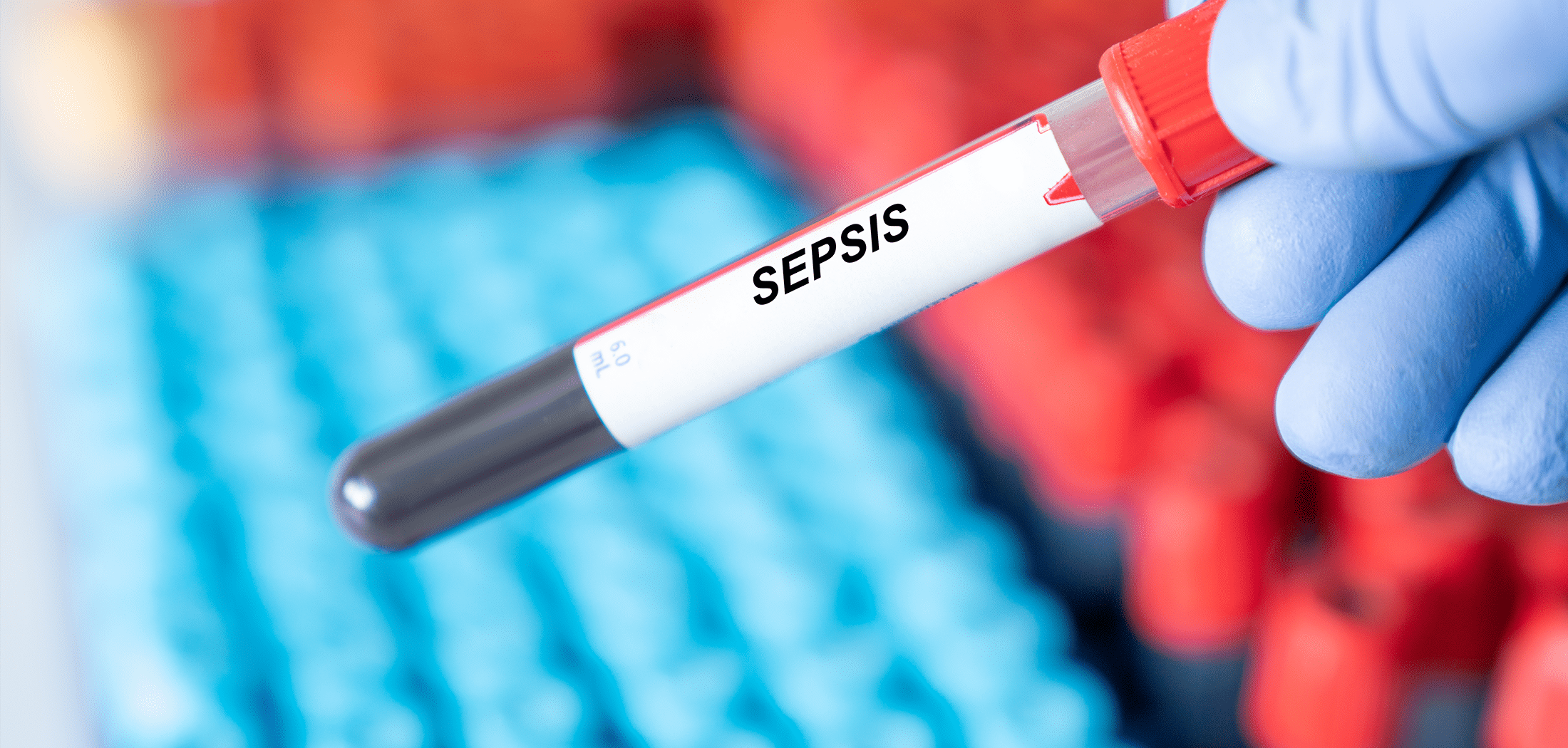 Sepsis disease blood test in doctor hand