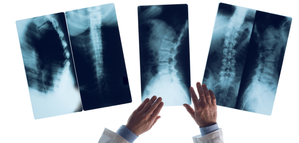 Spinal xrays